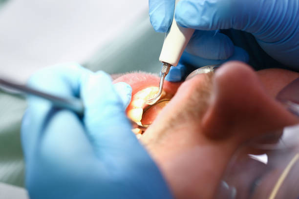 Best Knocked-Out Tooth (Avulsed Tooth) Treatment in Highfill, AR