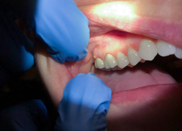 Best Lost Filling or Crown Replacement in Highfill, AR